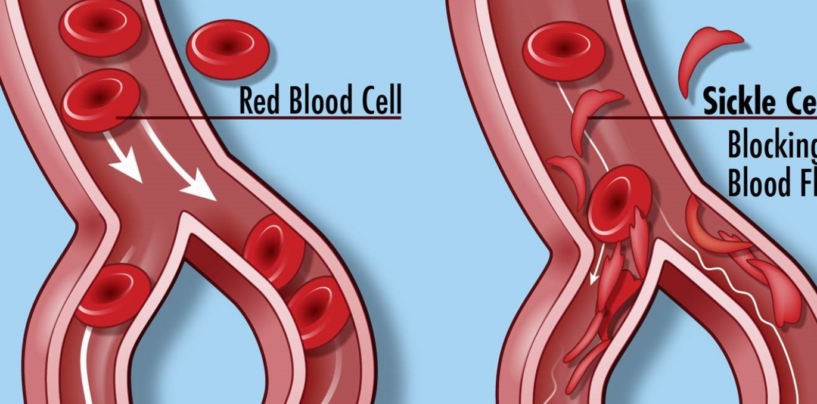 FDA Approves Groundbreaking Cell-Based Gene Therapies for Sickle Cell Disease