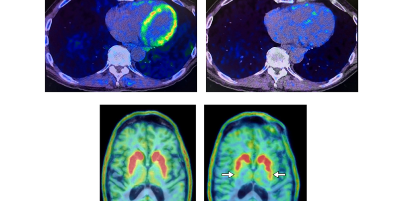 Revolutionary Study Explores Heart PET Scans as Game-Changer for Early Parkinson’s and Lewy Body Dementia Detection